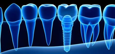 3D Dental Scanning Technology Maximizes Precision in Dental Implant ...