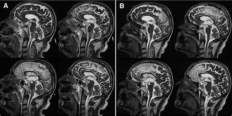 Gaba B Receptor Antibodies In Paraneoplastic Brainstem Encephalitis Journal Of Neuroimmunology