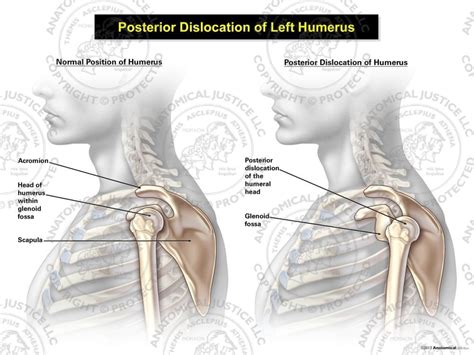 Male Posterior Dislocation of the Left Humerus