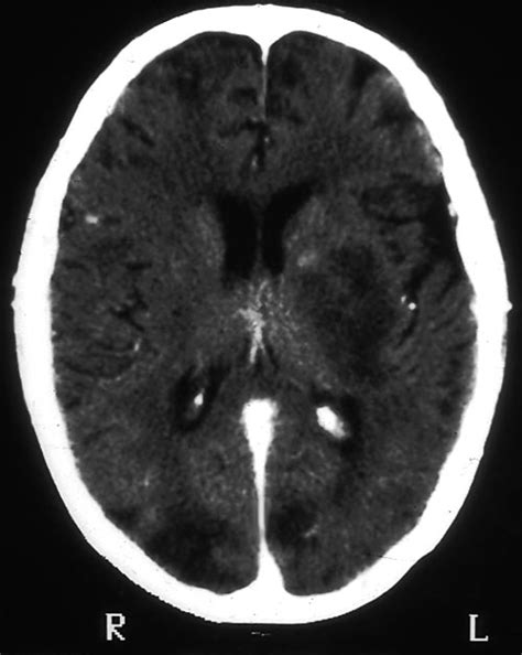 brain2 - Aspergillus and Aspergillosis