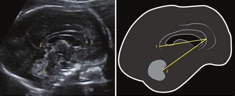 Prenatal Measurement Of Cc And Ccf Lengths 1 Corpus Callosum Length