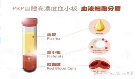 再生治疗的新希望——prp治疗技术 知乎