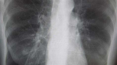 COPD X-Ray: Pictures, Diagnosis, and More