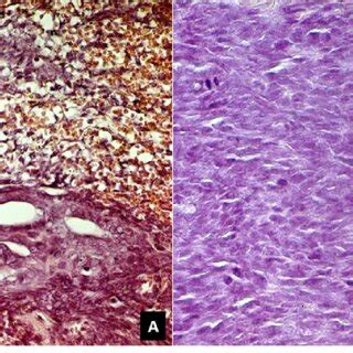 A HE Â 100 biphasic synovial cell sarcoma detailing the spindle cell