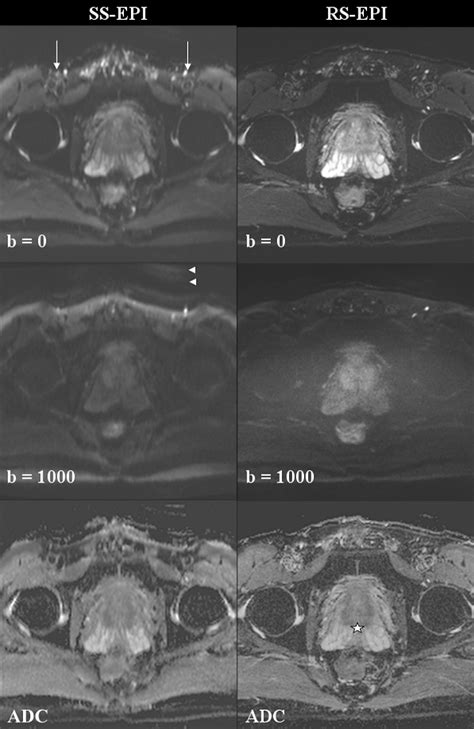 Figure 2 From Readout Segmented Echo Planar Imaging For Diffusion