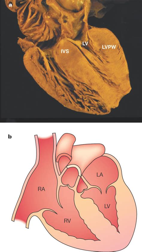 Hypertrophic Cardiomyopathy A Heart From An Individual With