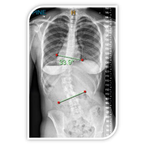 Case Study Bracing Of Adolescent With Idiopathic Scoliosis