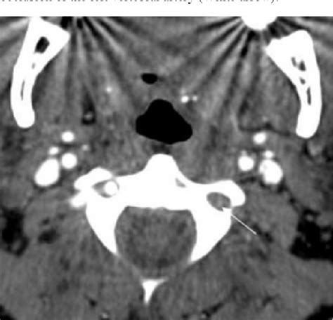 Figure 1 from Hypoplastic Vertebral Artery as a predisposing cause for dissection | Semantic Scholar