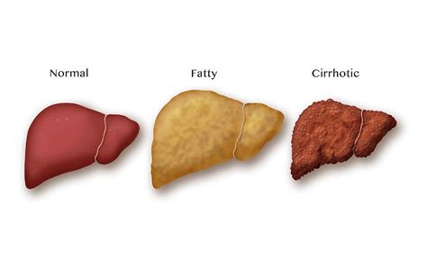 Liver Disease Progression Illustration Photograph By Monica Schroeder