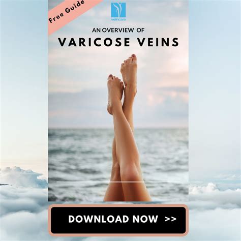 Free Guide On Varicose Veins At Vein Care Treatments