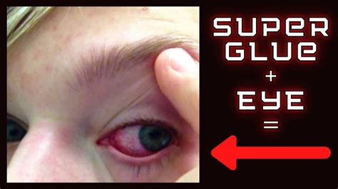 I Super Glued My Eye Shut Surviving Super Glue In Your Eye Story