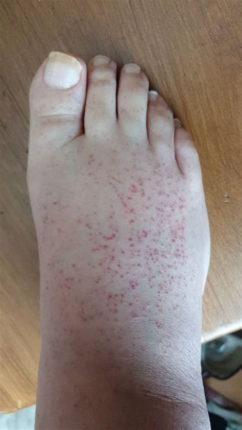 Diabetic Rash On Top Of Foot Deals | emergencydentistry.com