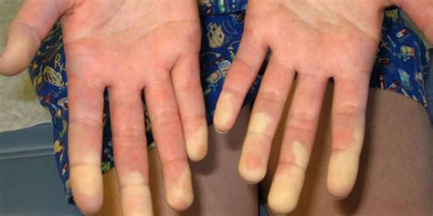 Sindrome Di Raynaud Sintomi Esami E Cure Roba Da Donne