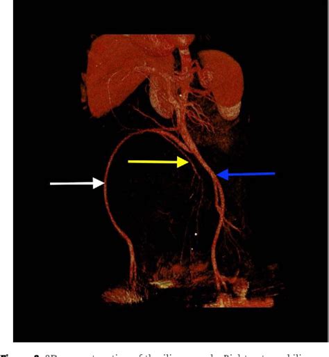 Figure 1 From A Huge Retroperitoneal Cyst With A Rare Clinical