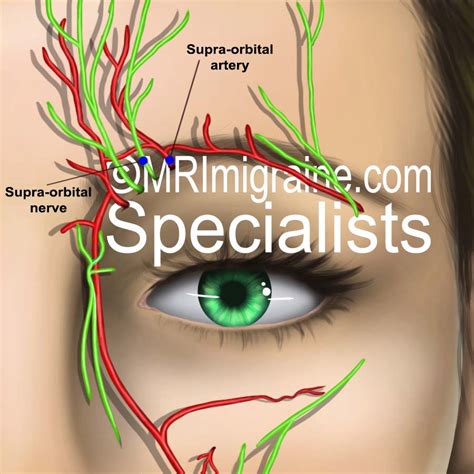 Supraorbital Nerve Decompression In The Treatment Of Frontal Migraine