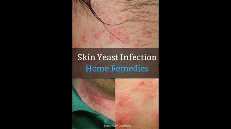 Candidiasis Skin Rash