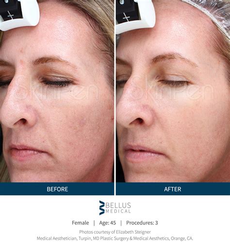 Microneedling With PRP Platelet Rich Plasma Tribeca Skin Center