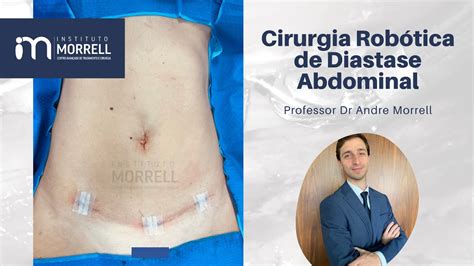 Diastase Abdominal Por Rob Tica Dr Andre Morrell Youtube