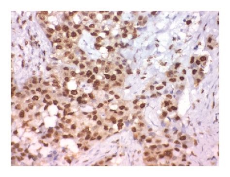 Immunohistochemical Staining Of P38 In Transitional Cell Carcinoma