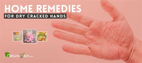 10 Best Home Remedies For Dry Cracked Hands That Work [naturally]