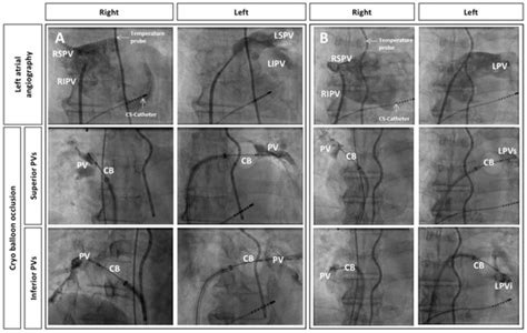 A Simplified Approach To Pulmonary Vein Visualization During Cryoballoon Ablation Of Atrial