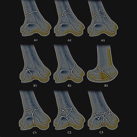 Distal Femur Fracture Classification