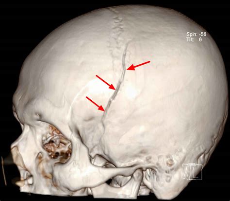 Epidural hematoma causes, signs, symptoms, diagnosis & treatment