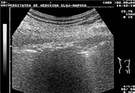 Calcified pachipleuritis – hypoechoic thickening of the pleura with ...