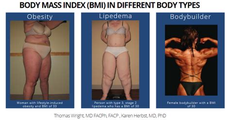 Lipedema Obesity And Increased Bmi Lipedema