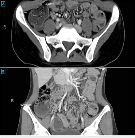 Ct Of The Abdomen And Pelvis Terminal Ileitis Evidenced By An Download Scientific Diagram