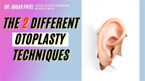 The 2 Different Otoplasty Techniques YouTube