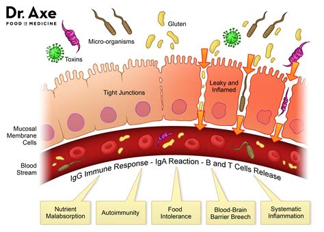 This Diagram Of Leaky Gut In The Gut Lining May Help You Figure Out How