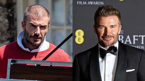 Beckham Hair Transplant - SULE HAIR TRANSPLANT