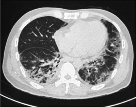 A Bad Sign Dermatomyositis With Interstitial Lung Disease The