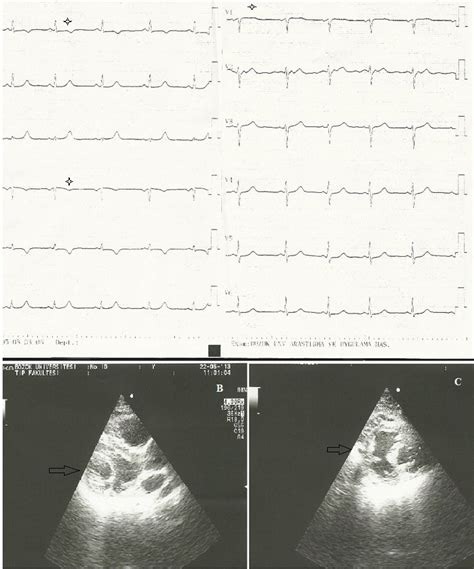 A The Electrocardiography Showed Normal Sinus Rhythm With T Wave