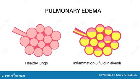 Pulmonary Edema Is Shown Good And Bad Alveoli Other Names Is Lung