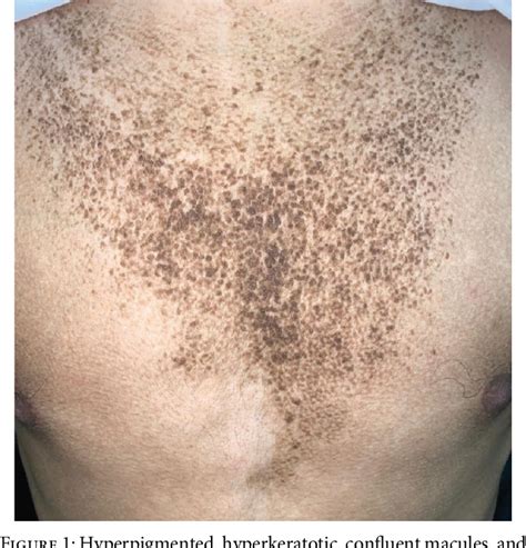 Figure 1 From Confluent And Reticulated Papillomatosis Successfully Treated With Topical Vitamin