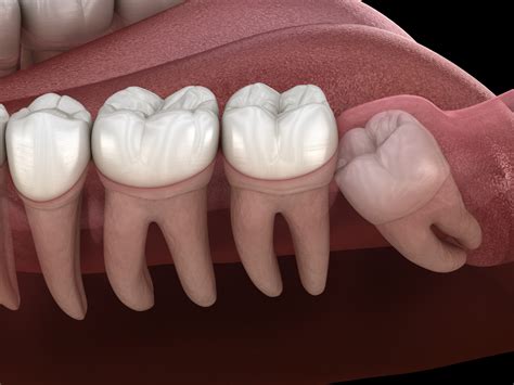 7 Signs You May Need Your Wisdom Teeth Removed Knoxville Oral And Maxillofacial Surgery