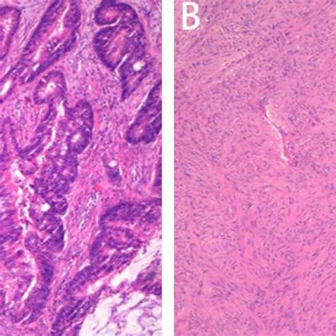 Photomicrographs A Moderately Differentiated Invasive Adenocarcinoma Download Scientific