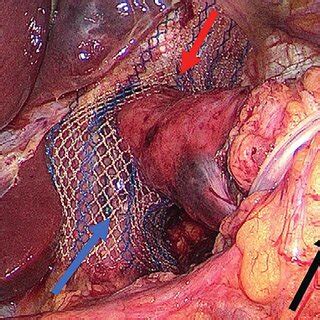 Hiatus Oesophagien Avec Renforcement Par Filet Fl Che Orange La