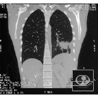 Tumor Shadow Was Revealed In Left Lower Lobe Of The Lung On Chest Ct