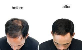 Biotin Hair Growth Results: Before & After Pictures • MixedUpBeauty®