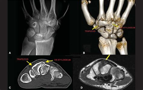 Scielo Brasil Carpal Boss Syndrome Os Styloideum Fused To The