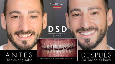 Dise O De Sonrisas Digital Dsd En Madrid Ori N Dental