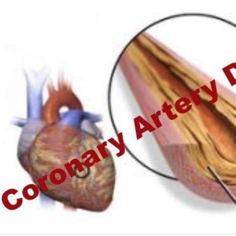 Stream episode Coronary Disease - Coronary Artery Disease - Ischemic ...