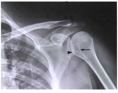 Gudang Medis Teknik Radiografi Shoulder Joint