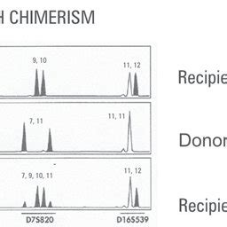 Examples Of Chimerism Analysis Results Using STR Analysis DNA Was