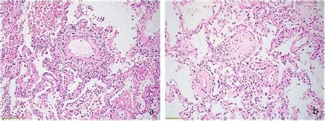 Acute Sars Cov Pneumonitis With Cytotoxic Cd Positive T Lymphocytes