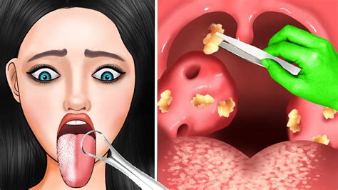 Asmr Powerful Tonsil Stone Treatment And Giant Tartar Removal Animation