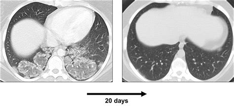 HRCT Scan Gallery Insights In ILD